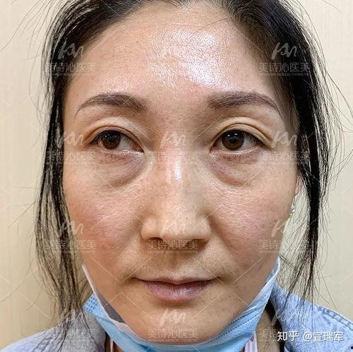 不开刀去眼袋视频,轻松告别眼部疲劳